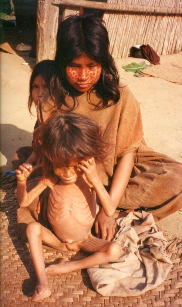 Población asháninka enferma por desnutrición
